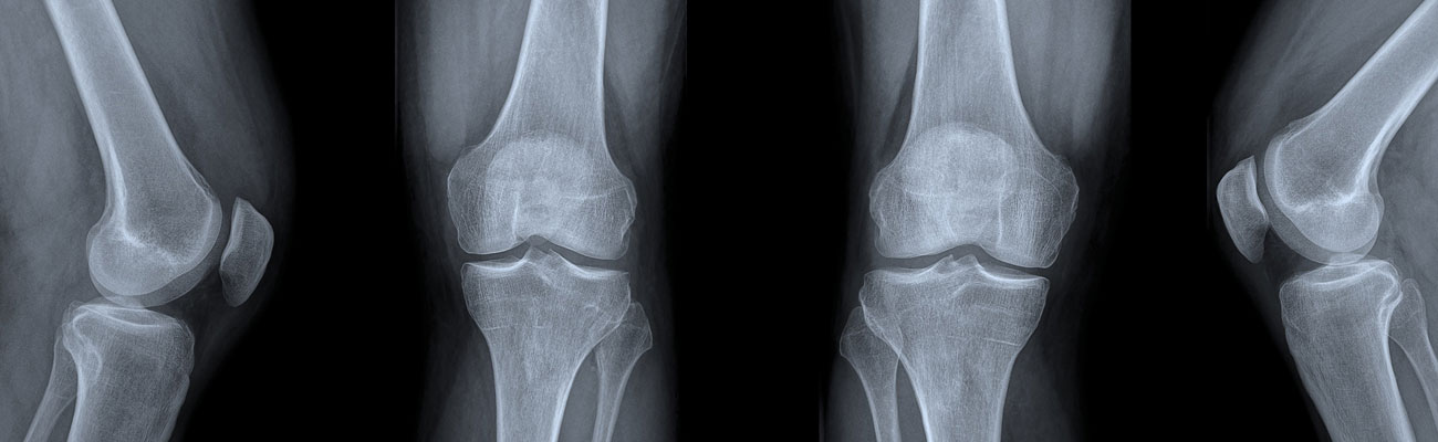 MBST®-KernspinResonanz-Therapie renoviert Knochen und Gelenke